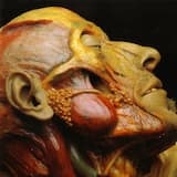 ... With the Rib Cage and All Major Organs Removed the Cadaver Was... (Stitched Up by a Mortuary Personnel)